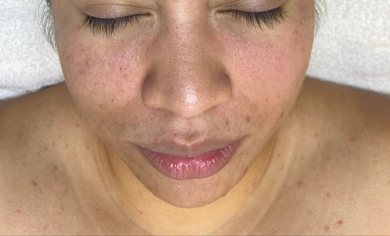 Person with a black headband on a white towel, possibly receiving a facial treatment.