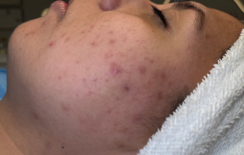 Person with a towel on their head, showing skin with visible blemishes.