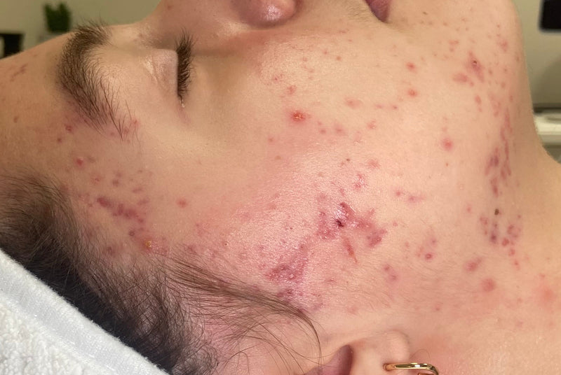 Person lying down with a white towel on their head, possibly receiving a facial treatment.